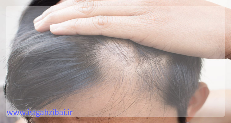 درمان خانگی و طبیعی ریزش موی سکه ای